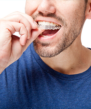 closeup of a person inserting their clear aligners onto their teeth