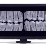 Cartoon image of bitewing X-ray images showing the teeth