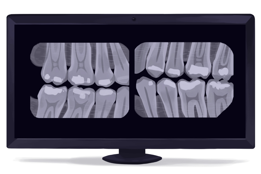 Cartoon image of bitewing X-ray images showing the teeth