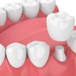A same-day CEREC dental crown tops a compromised natural tooth