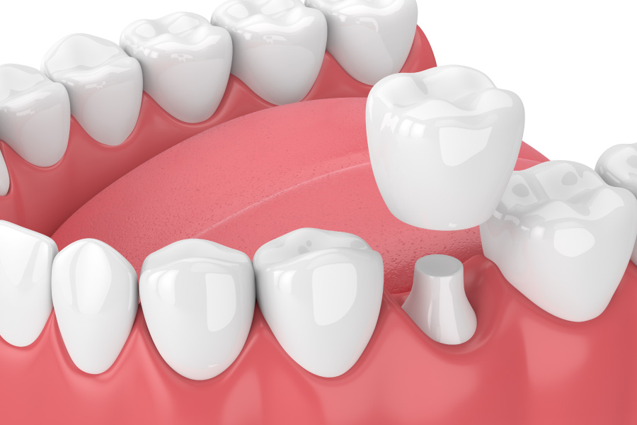 A same-day CEREC dental crown tops a compromised natural tooth