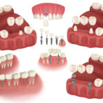 Different tooth replacement configurations with dental bridges and dental implants