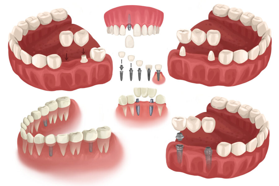 Different tooth replacement configurations with dental bridges and dental implants