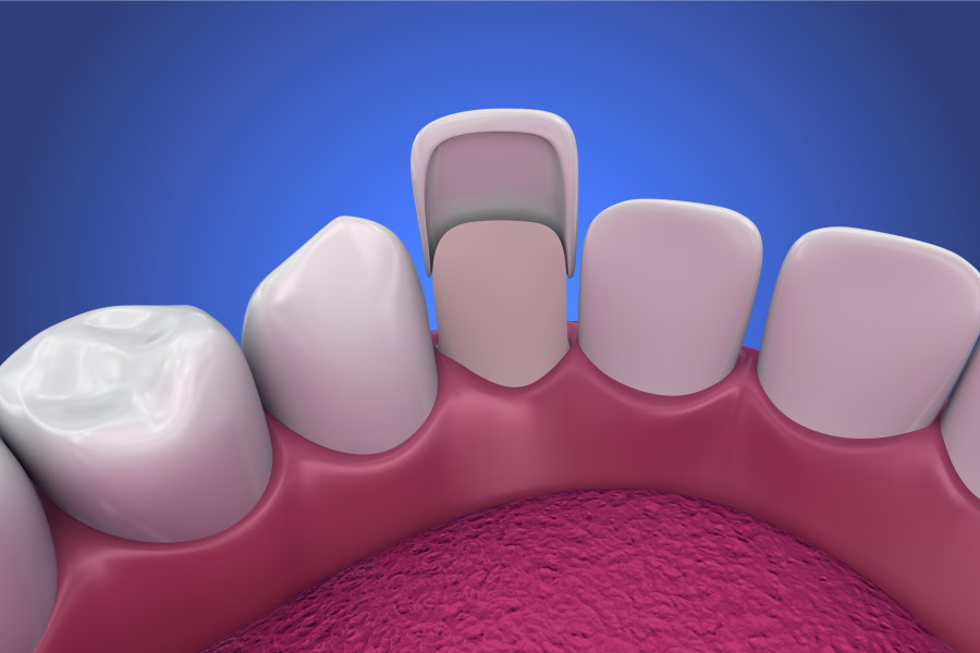 model of porcelain veneers process