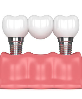 dental bridge shown against white background