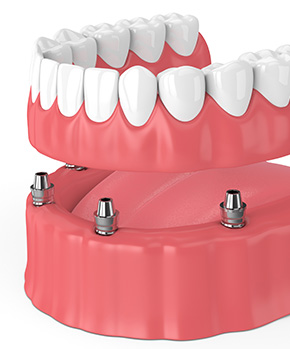 dentures shown above a gumline