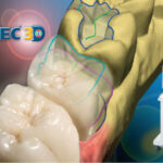 CEREC same-day crowns illustration