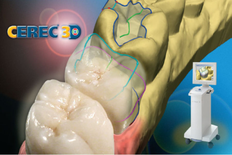 CEREC same-day crowns illustration