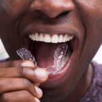man with candidpro clear aligners