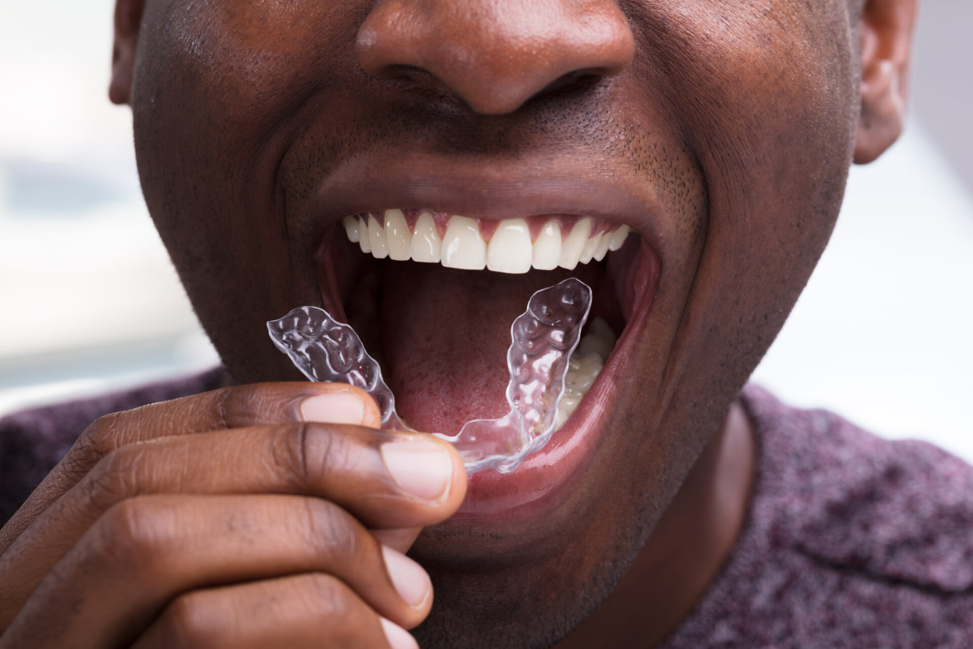 man with candidpro clear aligners