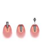 dental implant process, dental implant cost