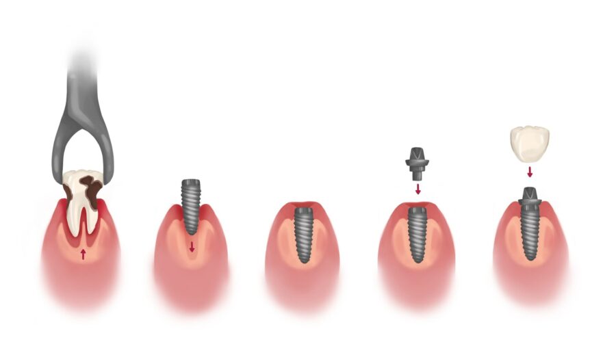 dental implant process, dental implant cost