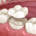 onlay ceramic crown, inlay, dental crown