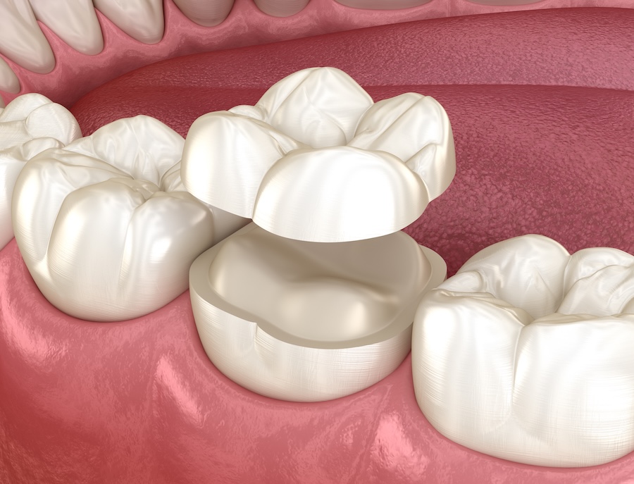 onlay ceramic crown, inlay, dental crown